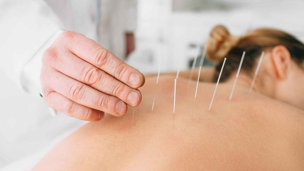 Acupuntura 